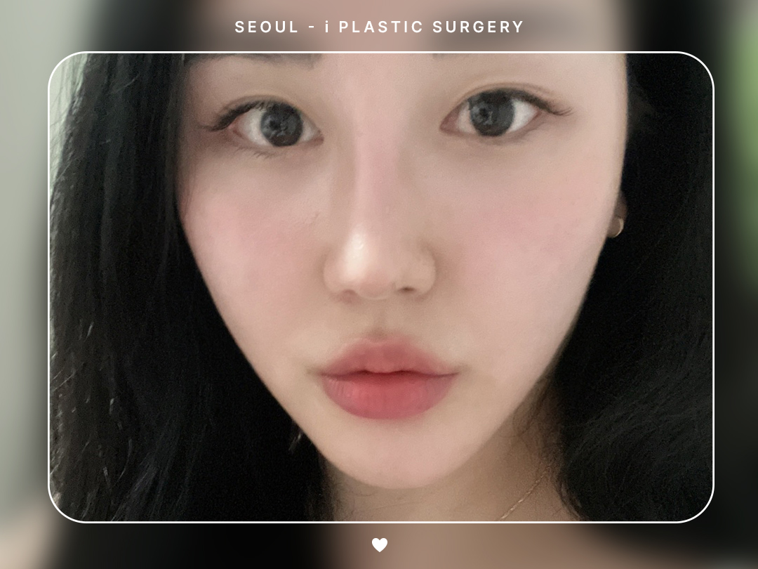 #얼굴지방흡입 #이중턱 #볼