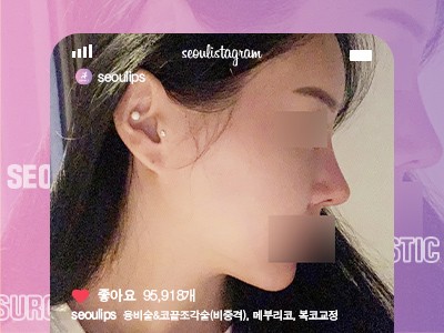 리얼셀카_#융비술&코끝조각술(비중격) #복코교정술 #메부리코