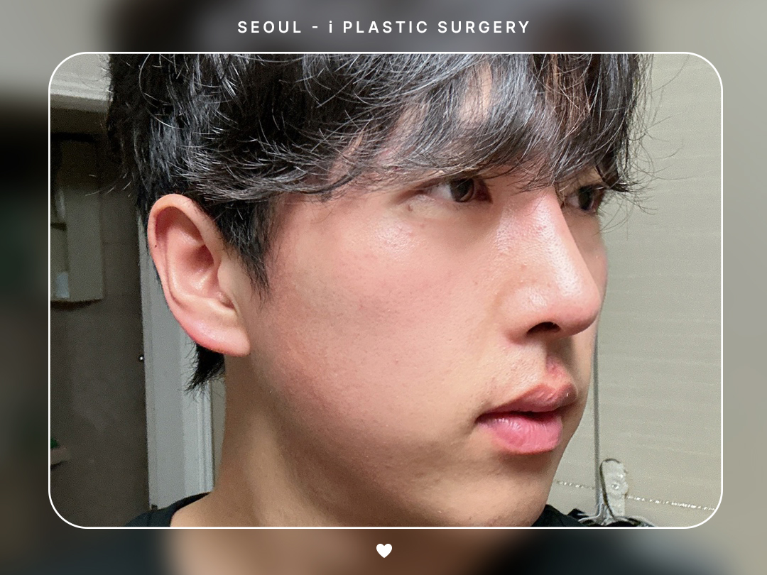 #자연유착 #눈매교정 #앞트임 #하거상술