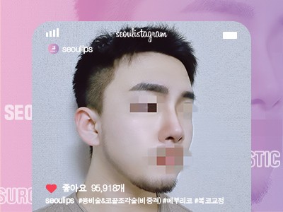 리얼셀카_#융비술&코끝조각술(비중격) #메부리코 #복코교정