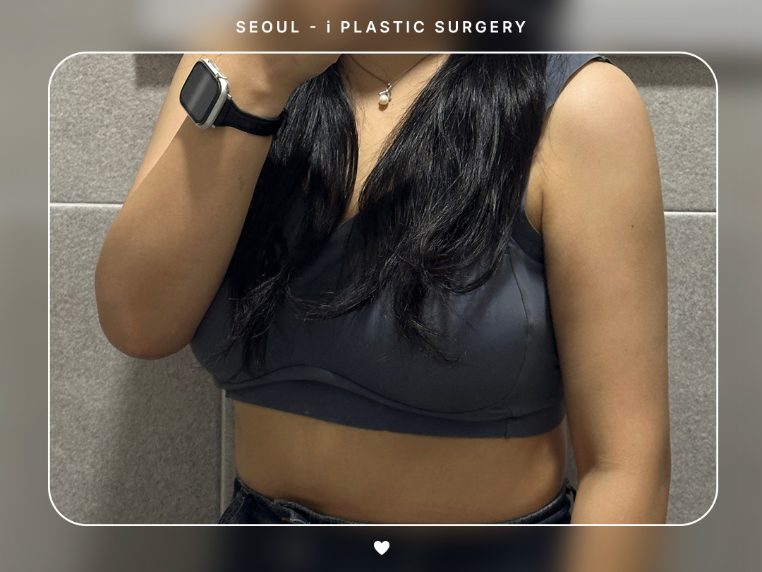 #바디지방흡입 #팔