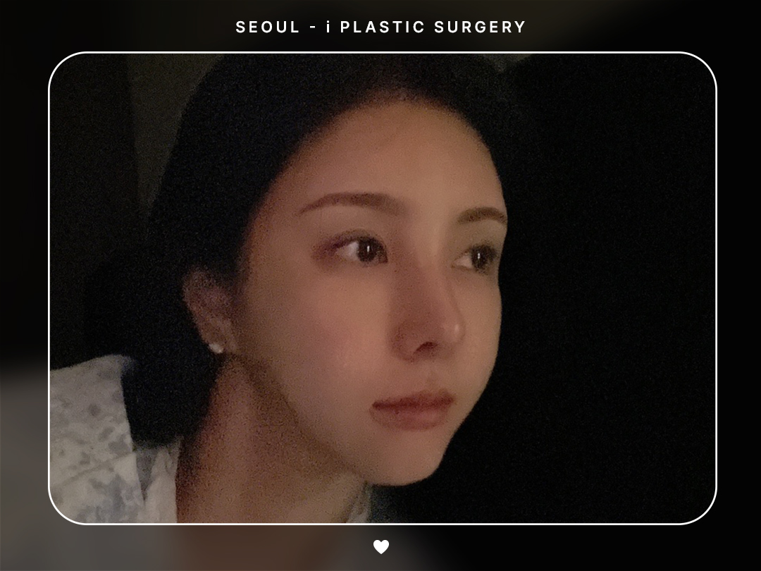 #모발이식 #비절개 #삭발