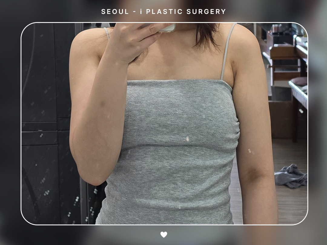 #지방흡입 #팔 #부유방
