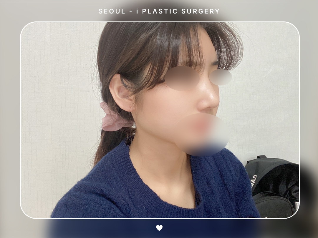 #미용코 #콧대 #매부리코교정