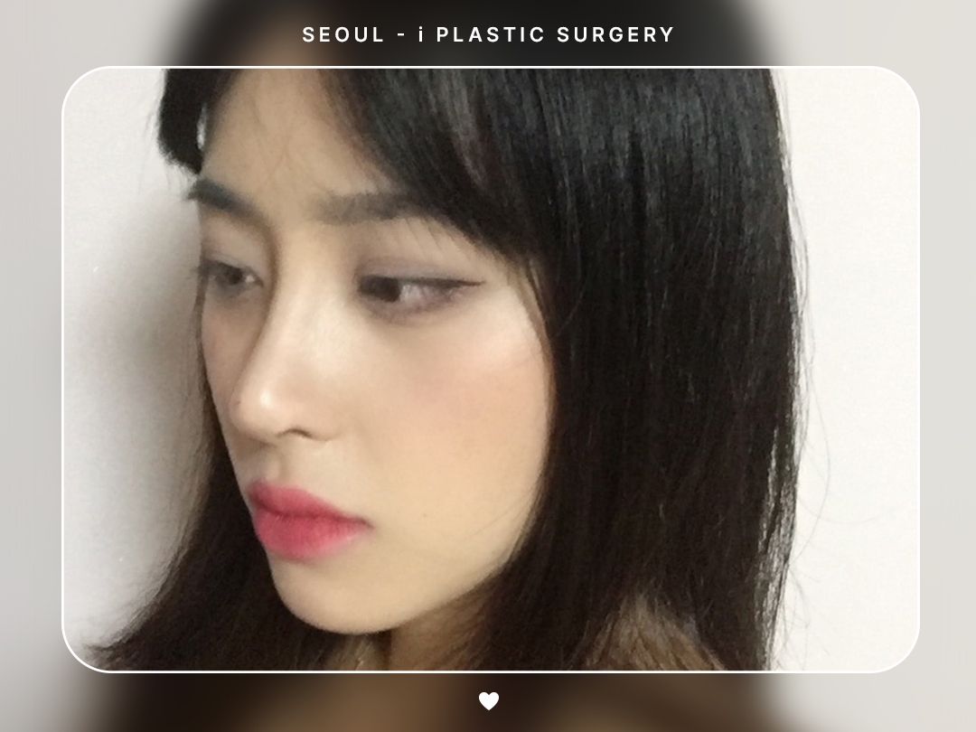 #미용코 #복코교정 #콧구멍내리기