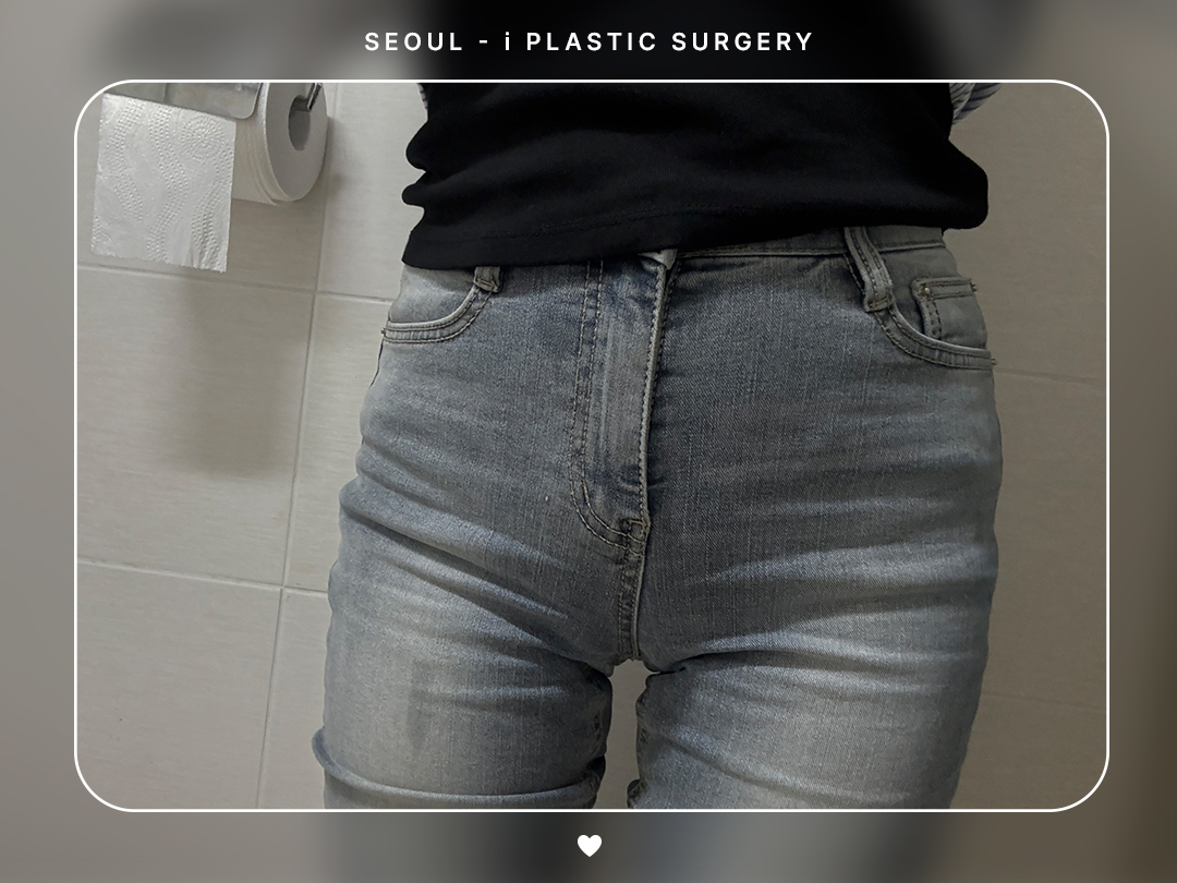 #바디지방이식 #PRP힙딥