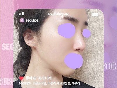 리얼셀카_#코끝조각술 #비중격 #복코교정술 #메부리코