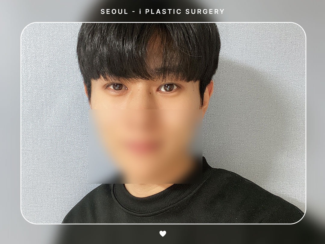 #자연유착 #앞트임