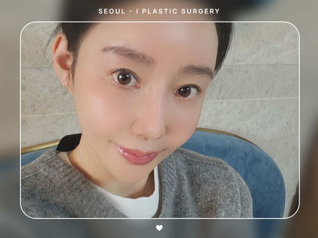 #미용코 #자가늑연골코재수술