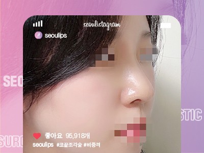 리얼셀카_#코끝조각술 #비중격