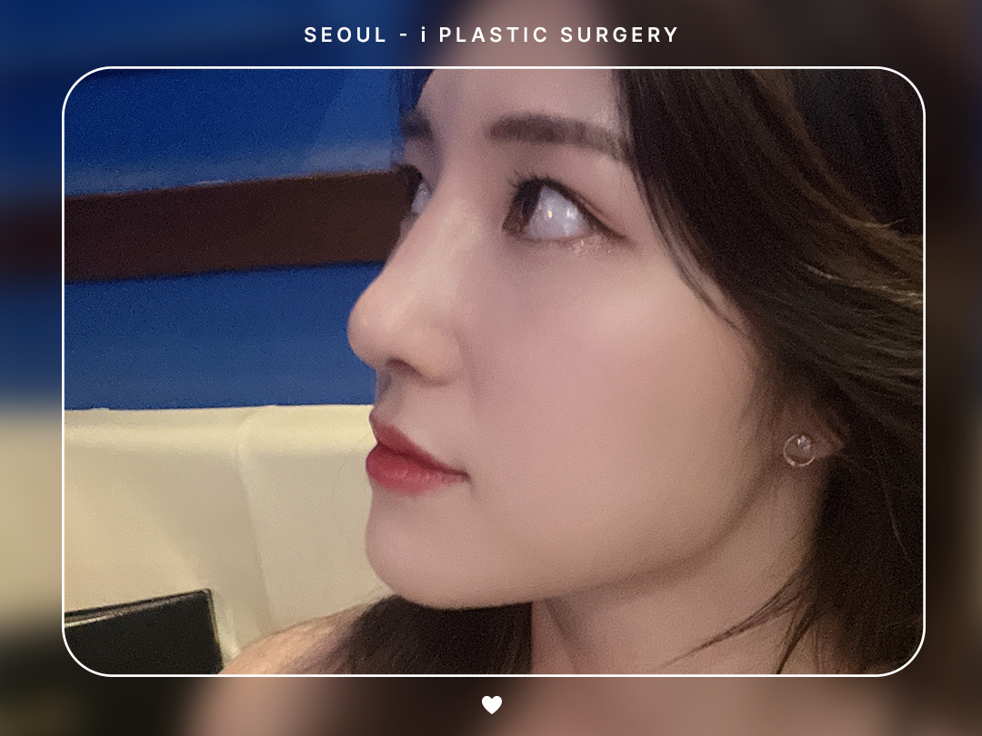 #미용코 #복코 #매부리코교정