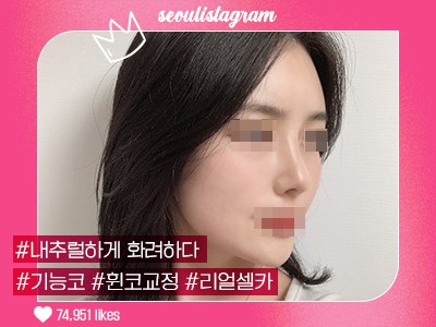 리얼셀카_#기능코성형 #휜코교정 #복코교정술 #매부리코