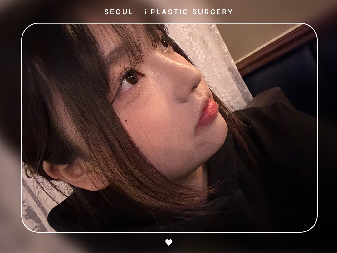 #미용코 #복코 #매부리코교정