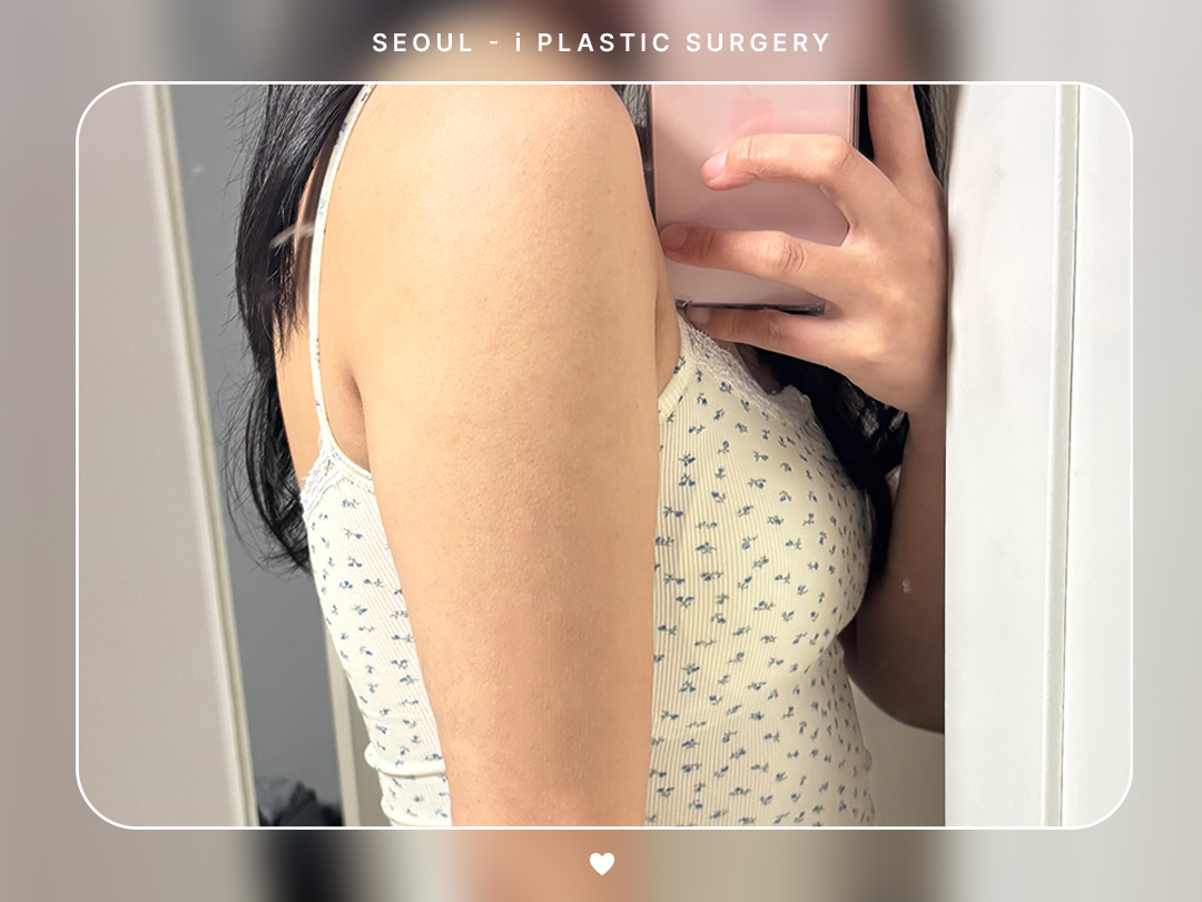 #바디지방흡입 #팔