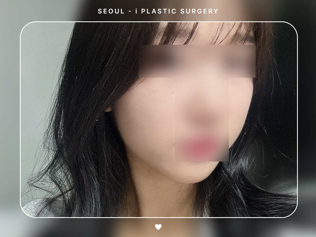 #얼굴지방흡입 #이중턱 #볼