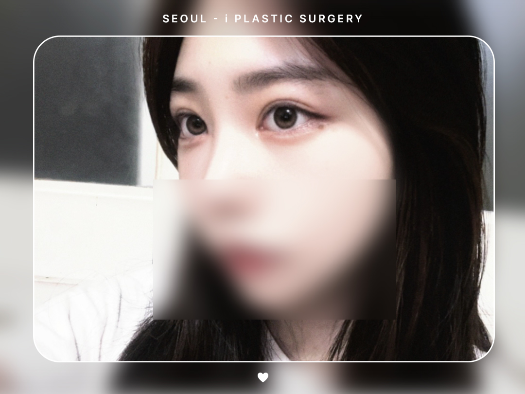 #자연유착 #앞트임