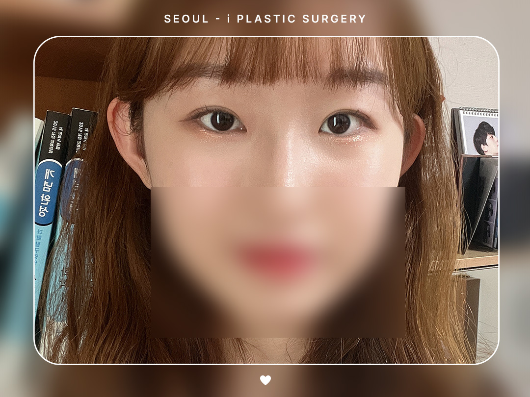 #자연유착 #앞트임