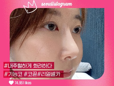 #코끝교정 #복코교정 #비공내리기