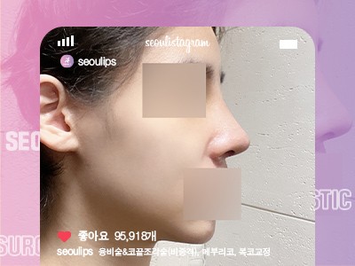리얼셀카_#융비술&코끝조각술(비중격) #복코 #메부리코