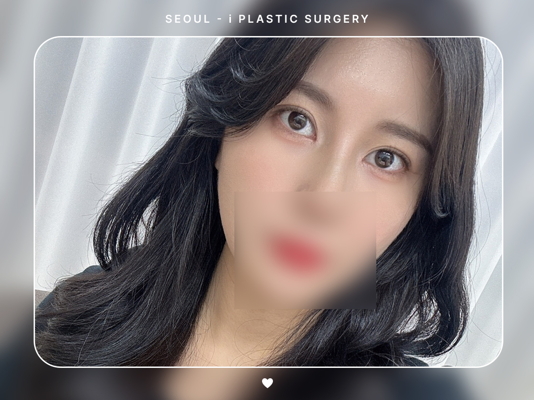 #자연유착 #앞트임