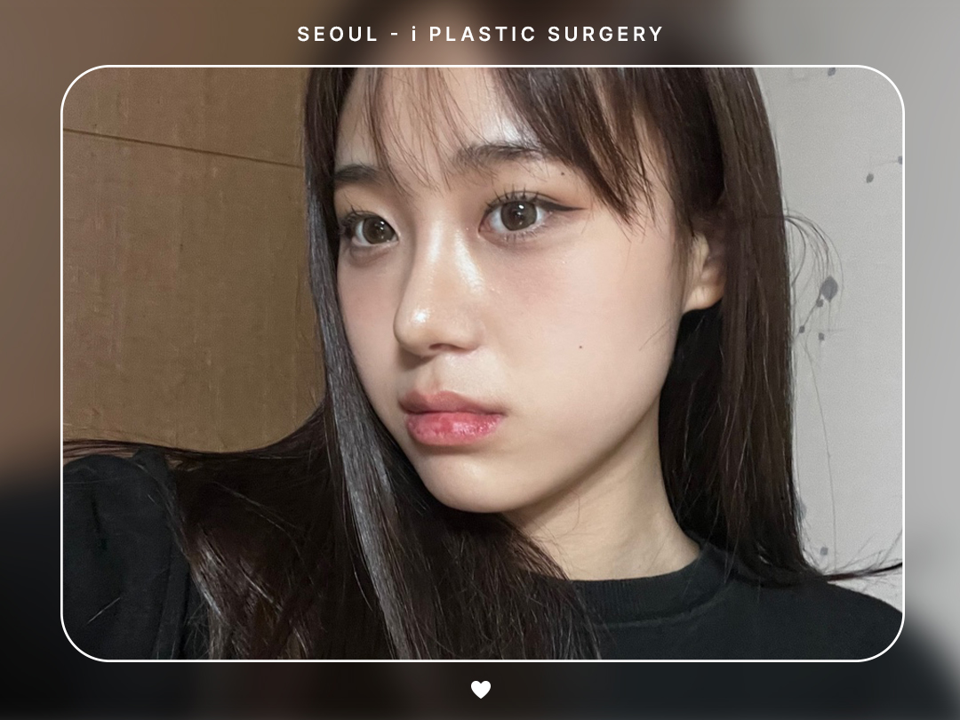 #미용코 #콧대 #매부리코교정