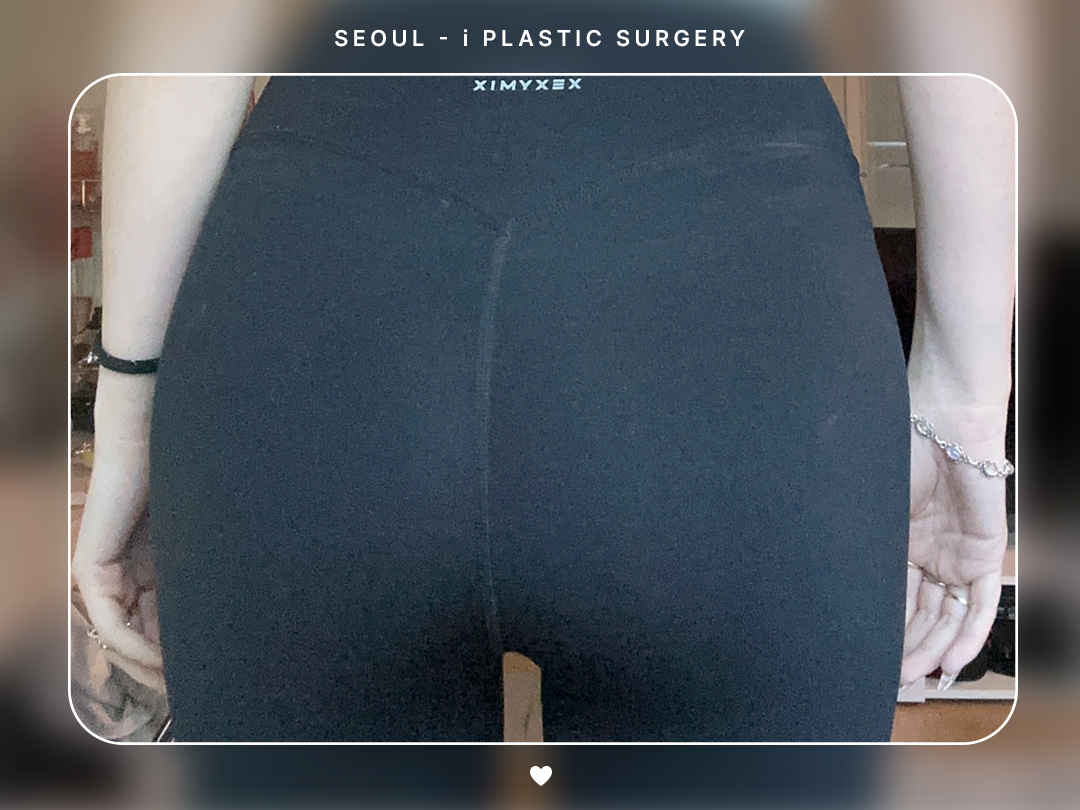 #바디지방이식 #PRP힙딥