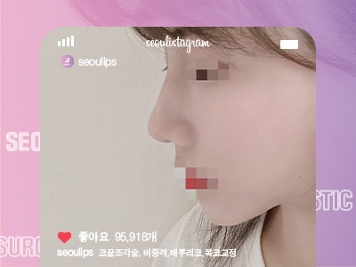 리얼셀카_#코끝조각술 #비중격 #복코교정술 #메부리코