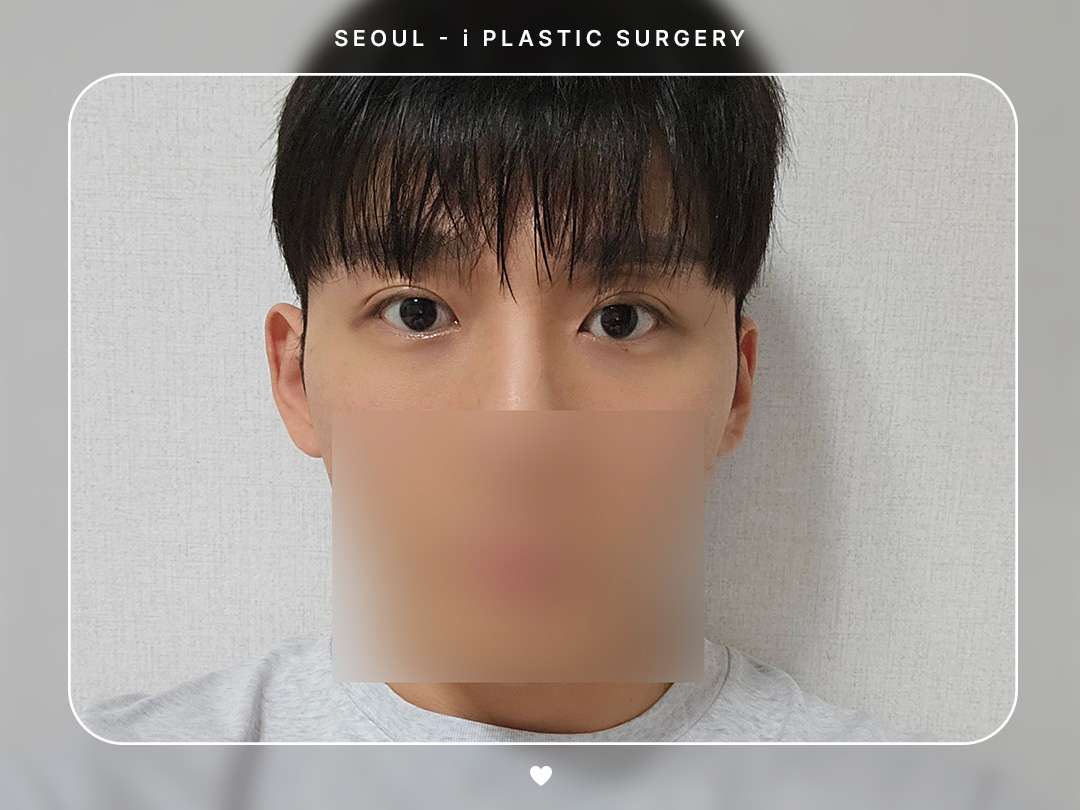 #남자눈 #자연유착쌍꺼풀