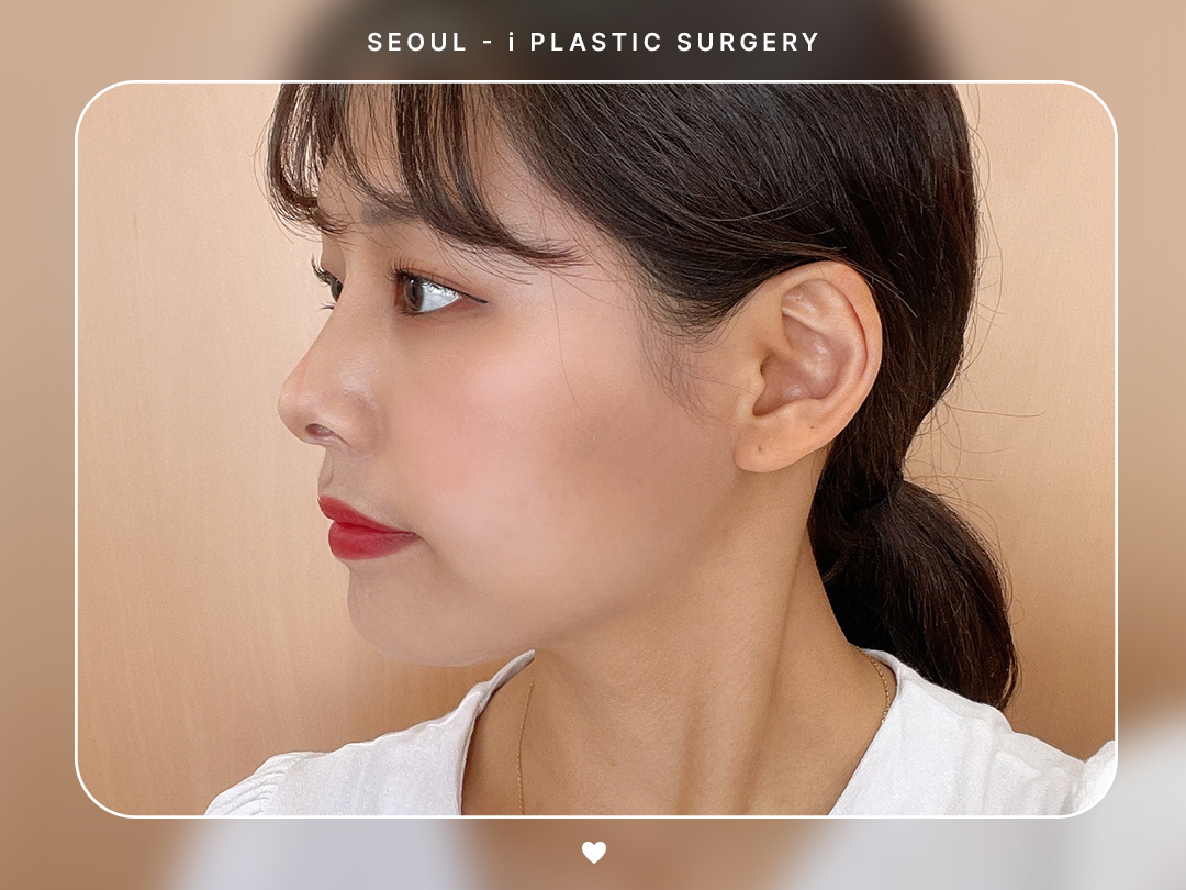 #미용코 #복코 #매부리코교정