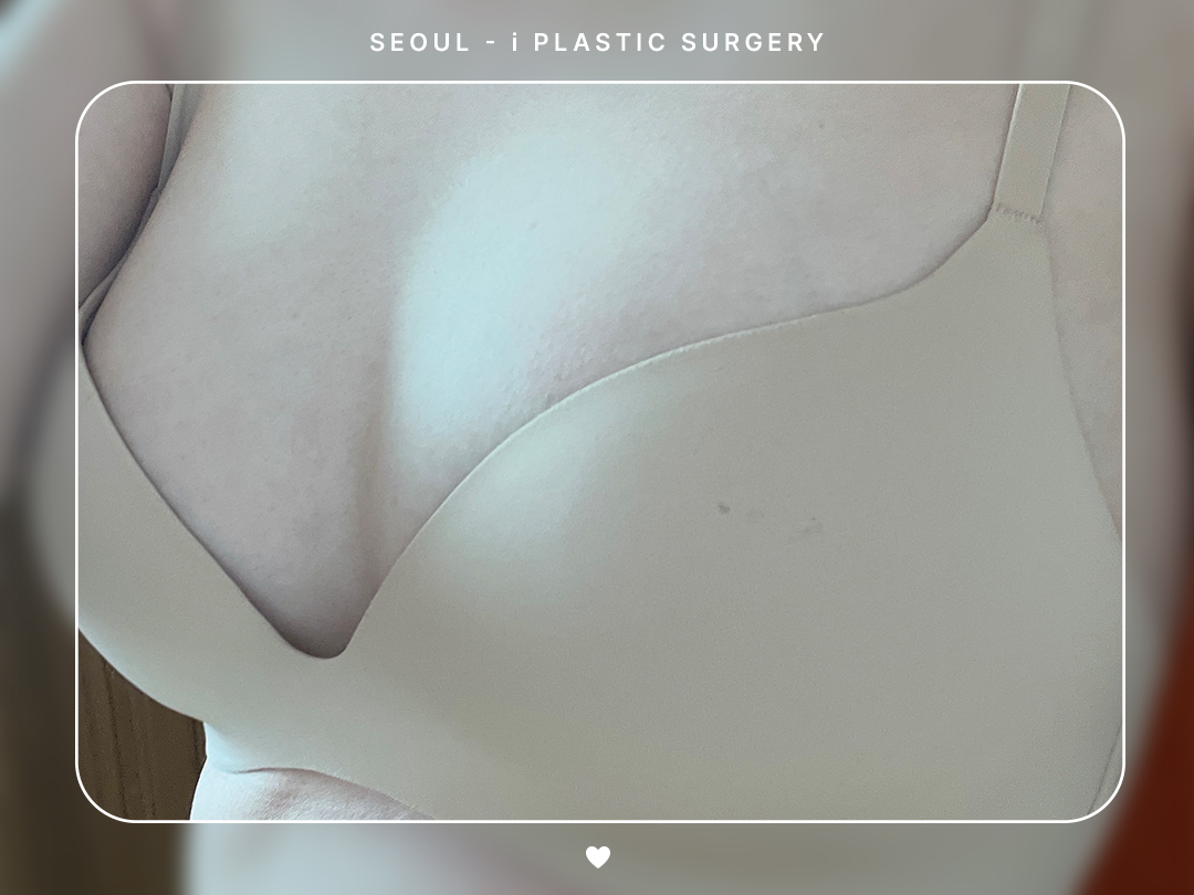 #가슴 #보형물 #내추럴가슴보형물