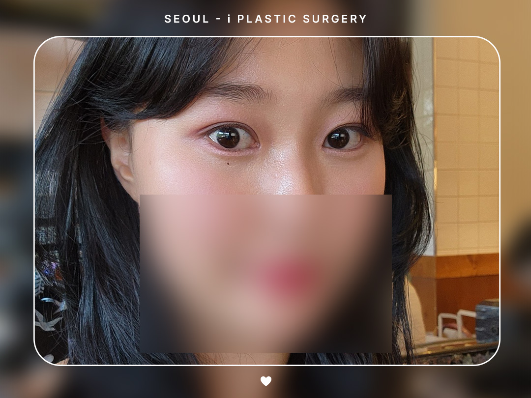 #자연유착 #앞트임