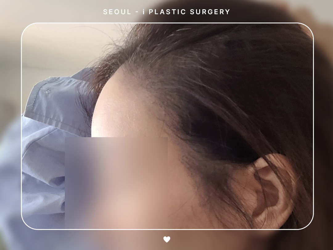 #모발 #절개 #모발이식
