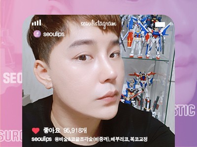 리얼셀카_#융비술&코끝조각술(비중격) #복코교정술 #메부리코