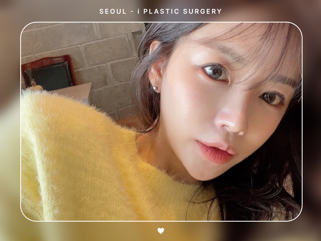 #미용코 #재수술 #복코 #콧대교정