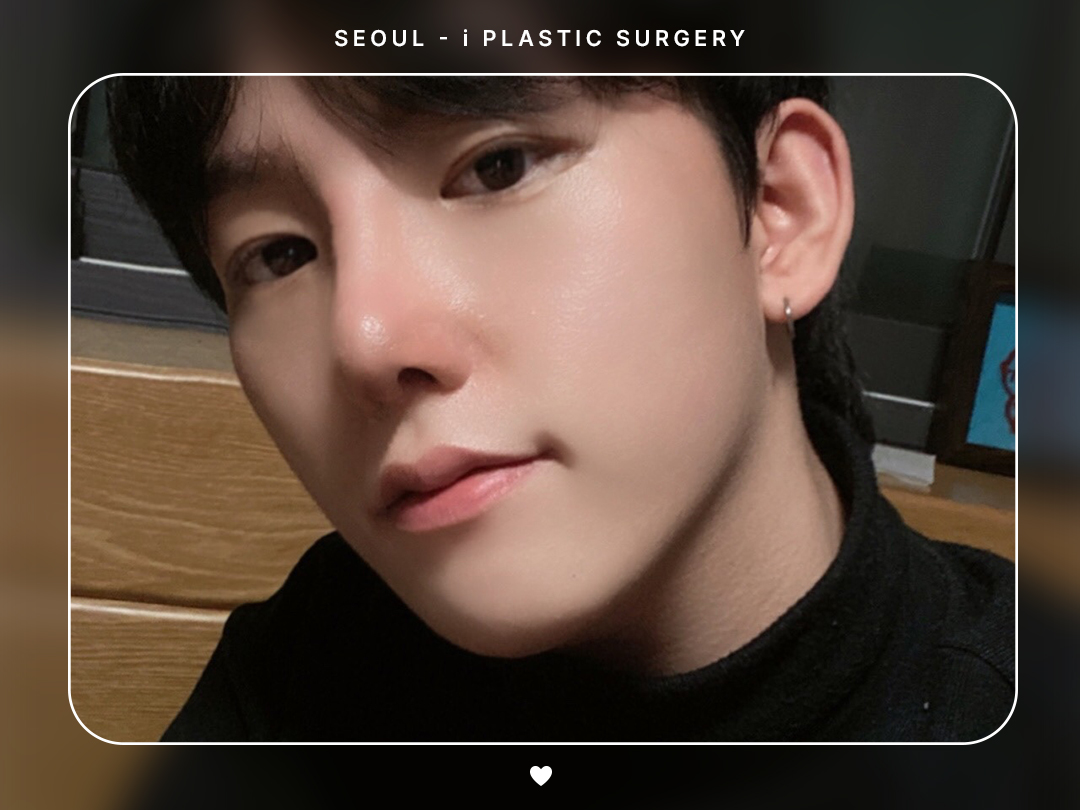 #미용코 #콧대 #코끝교정