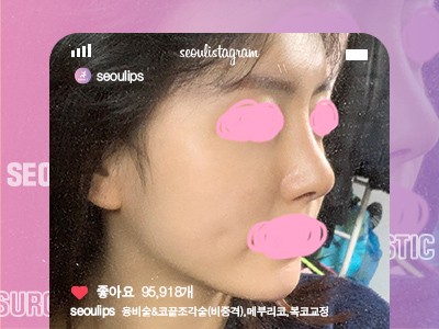 리얼셀카_#융비술&코끝조각술(비중격) #메부리코 #복코교정