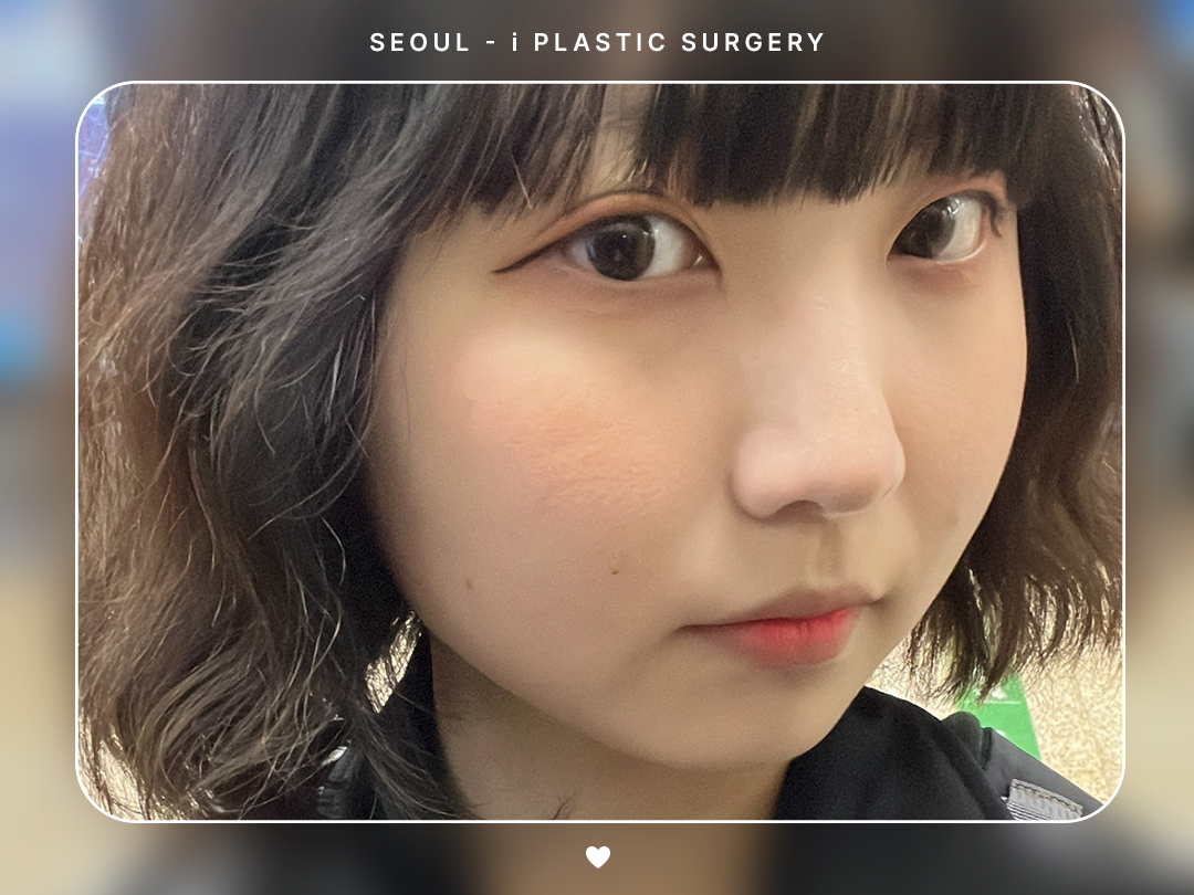 #미용코 #복코 #매부리코교정