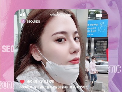 리얼셀카_#융비술&코끝조각술(비중격) #복코 #메부리코