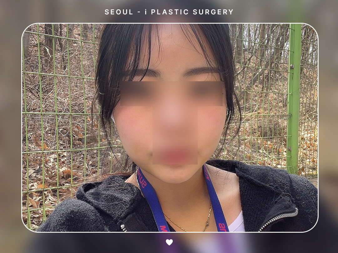#얼굴지방흡입 #이중턱 #볼