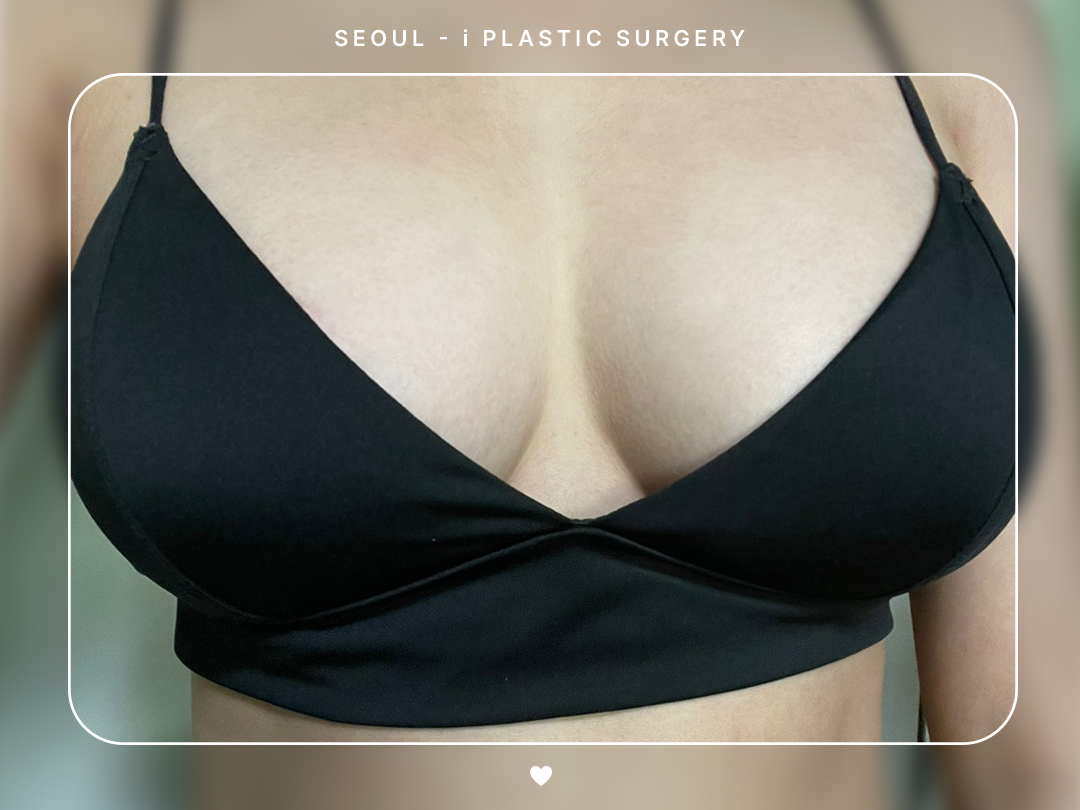 PRP 가슴지방이식