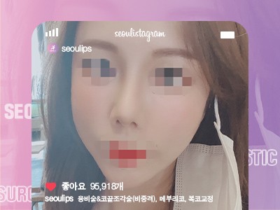 리얼셀카_#융비술&코끝조각술(비중격) #복코교정술 #메부리코