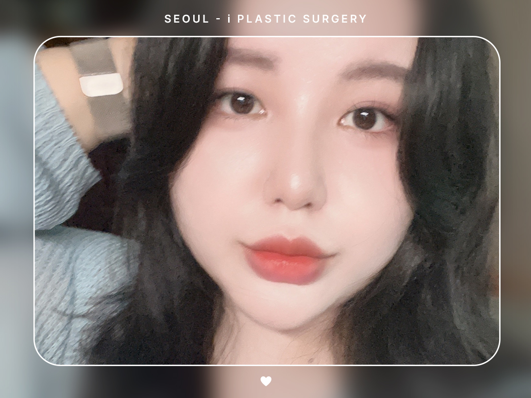 #미용코 #복코 #짧은코교정