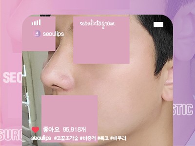 리얼셀카_#코끝조각술 # 비중격 #복코 #메부리