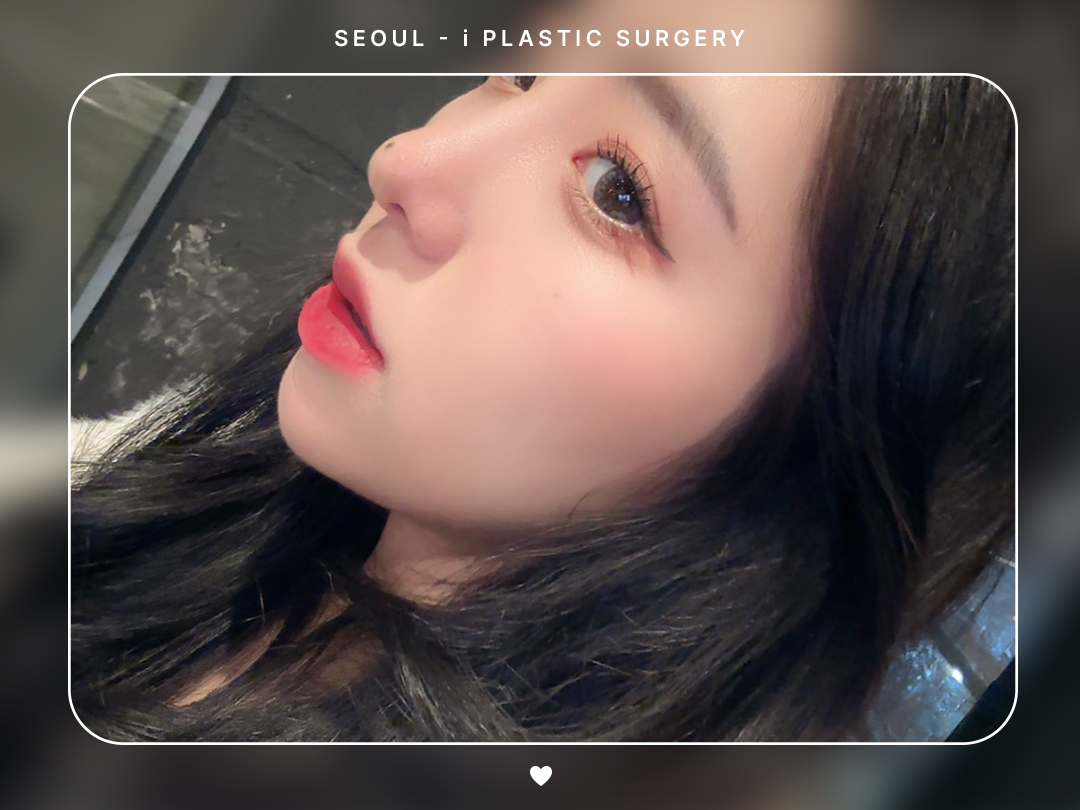 #미용코 #복코 #매부리코교정