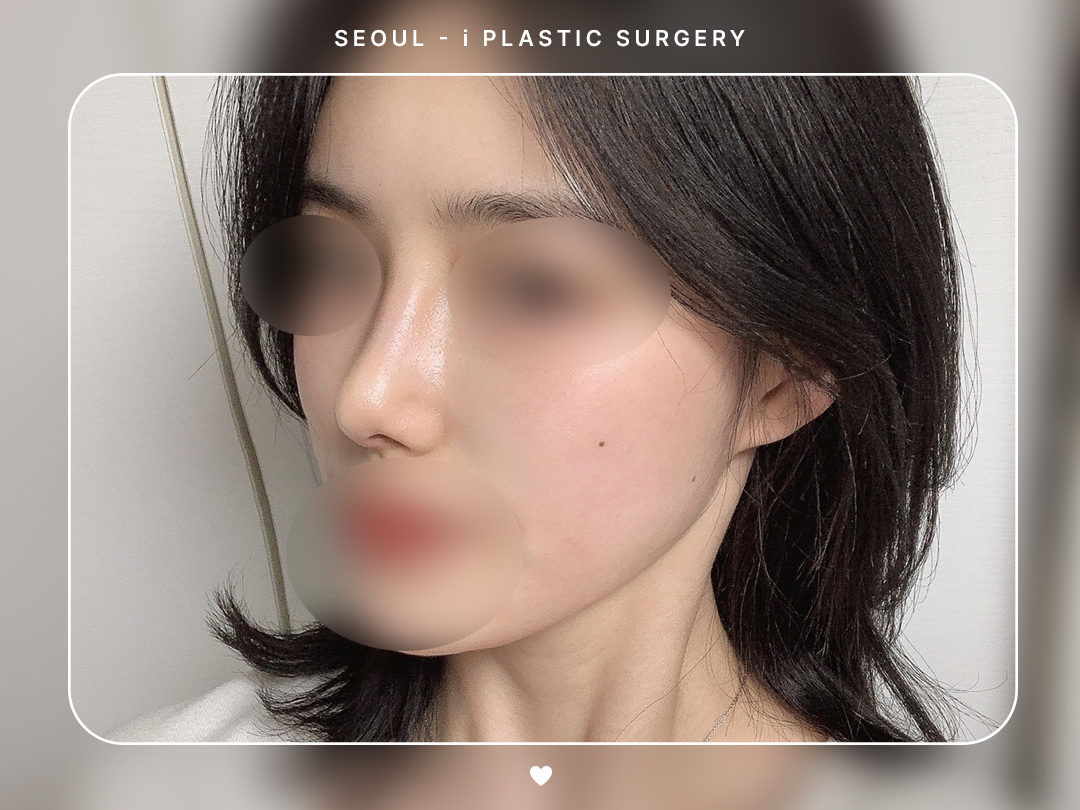 #미용코 #복코교정