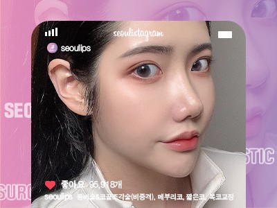 리얼셀카_#융비술&코끝조각술(비중격) #메부리코 #짧은코 #복코교정