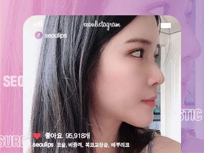 리얼셀카_#코끝조각술 #비중격 #복코교정술 #메부리코