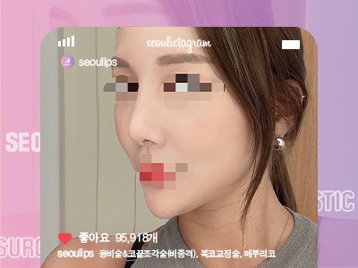 리얼셀카_#융비술&코끝조각술(비중격) #복코교정술 #메부리코