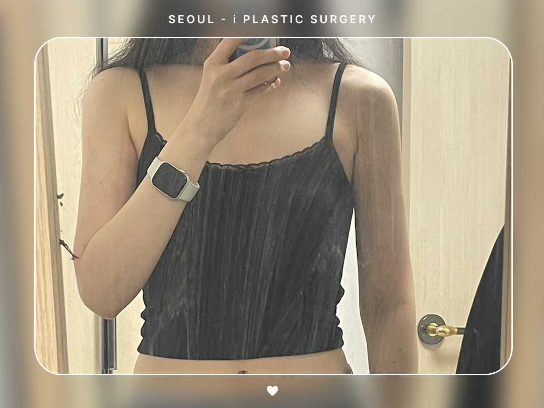 #바디지방흡입 #팔