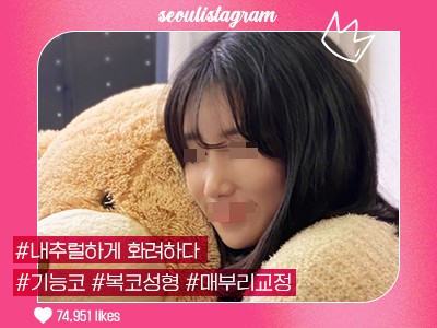 리얼셀카_#기능코성형 #복코교정 #코끝 #매부리교정